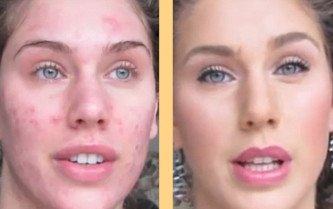 como fazer maquiagem para pele com acnes